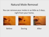 mole removal by string