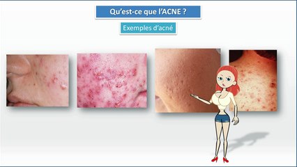 Lily James: L’acné est une vraie souffrance"